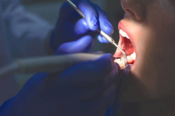 Dentalno čišćenje