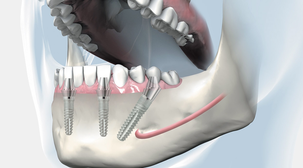 Dentalni implantati